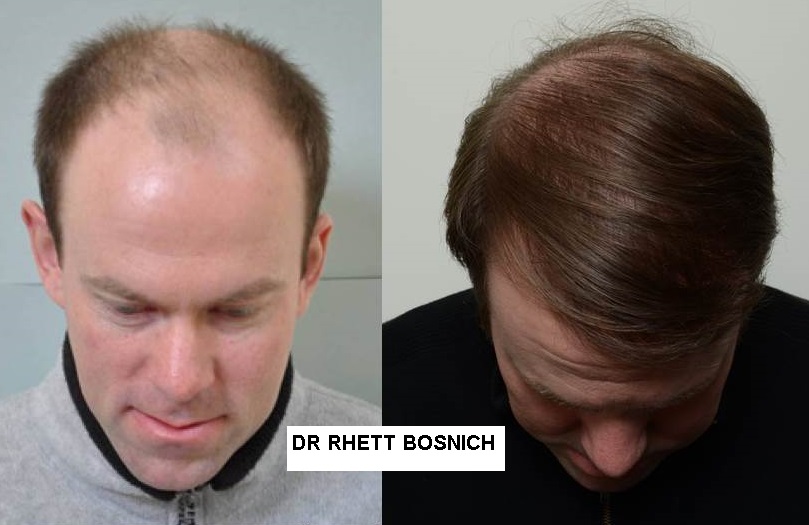 regrow hair laser